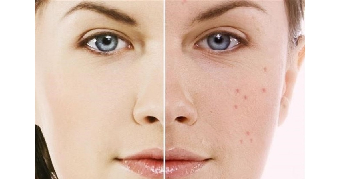 روتین کامل پوست چرب و مختلط کوزارکس + پاکسازی عمقی و رفع جوش و جای جوش