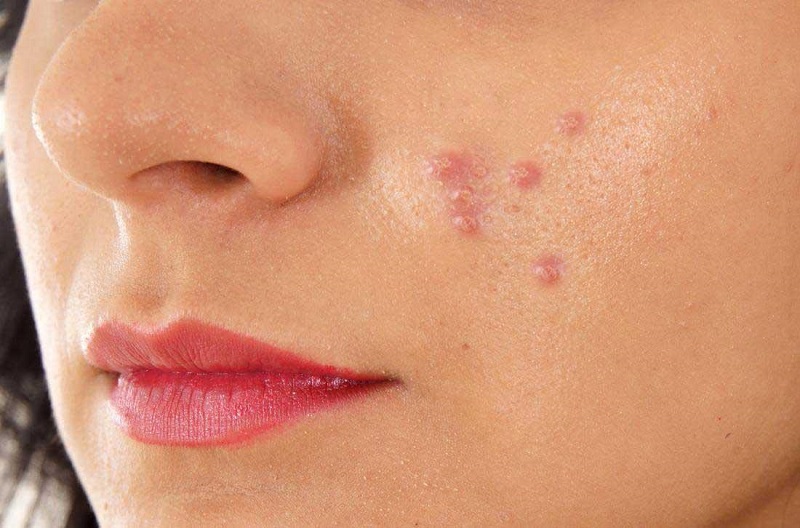 کرم ضد جوش و لک آلتیمیت اسپات کوزارکس + خشککننده جوش و از بین برنده جای جوش + اصل کره